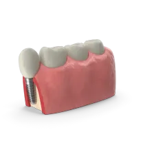 Консультация Имплантолога