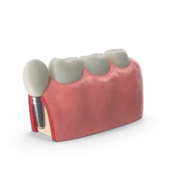 Консультация Имплантолога