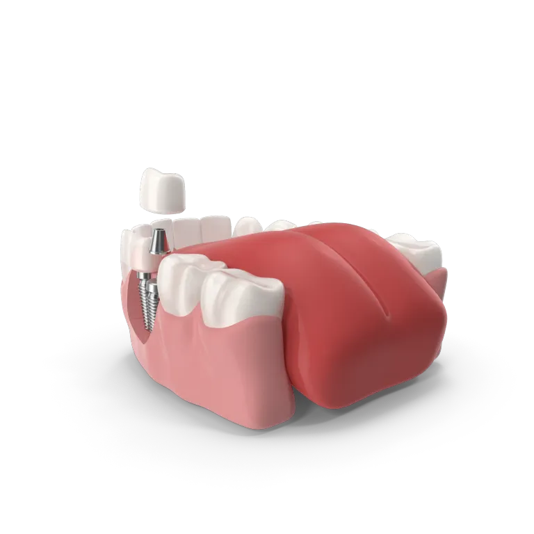 Имплантация зубов
